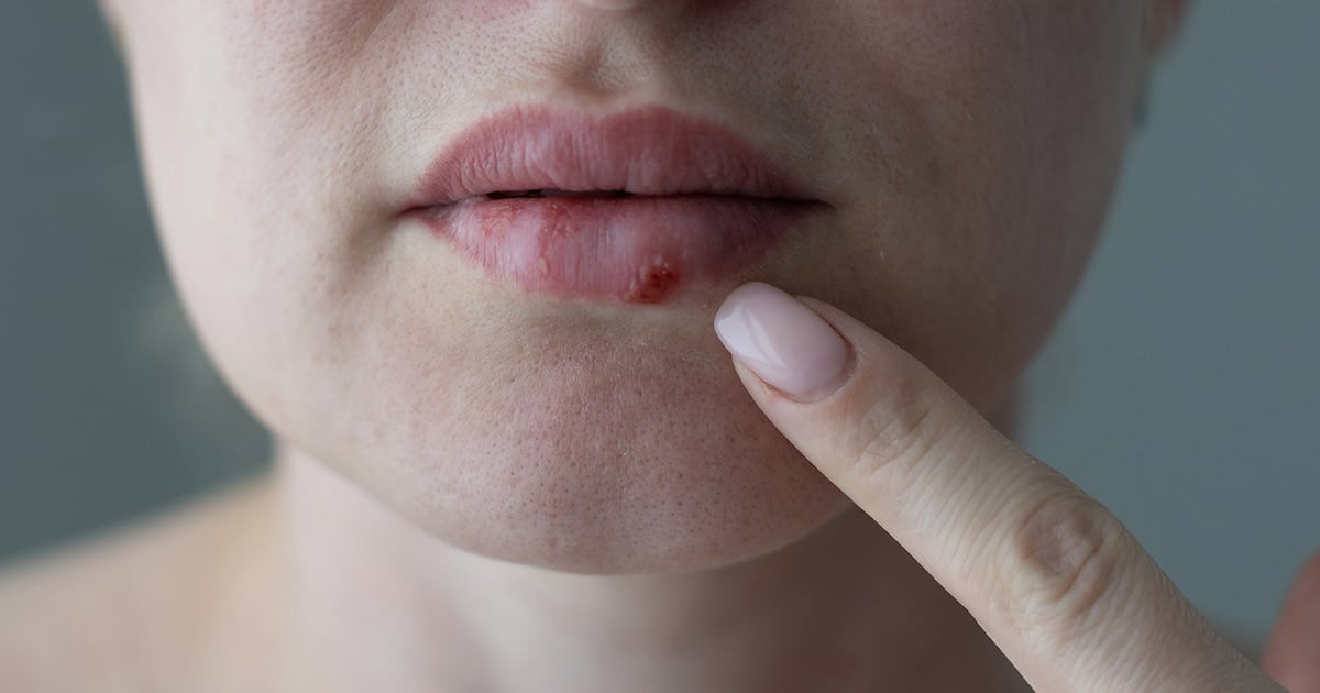 Aprobaron en Estados Unidos un antiviral oral que rompe casi 30 años de estancamiento contra el herpes resistente