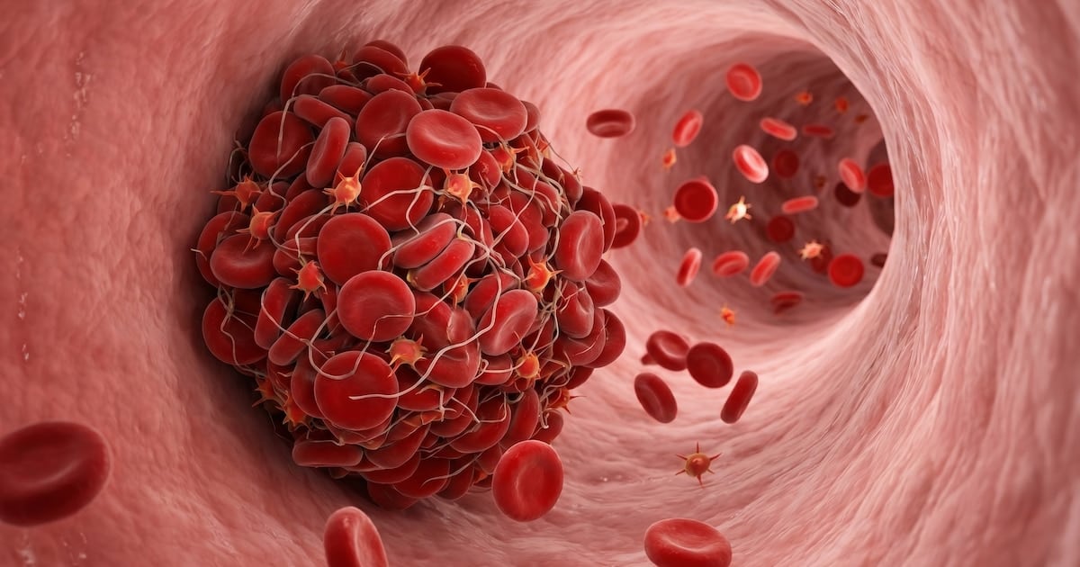 Cuando una pierna se vuelve la señal de alerta: cómo reconocer a tiempo un coágulo de sangre